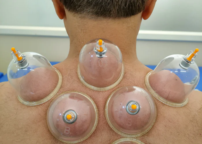Hijama (cupping therapy) à Marrakech dans un cadre professionnel